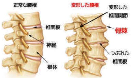 腰椎変性